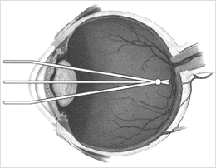 Myopia - Refractive Conditions