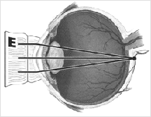 Presbyopia - Refractive Conditions